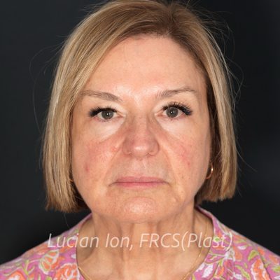 Before deep contouring neck lift, case 7, front view