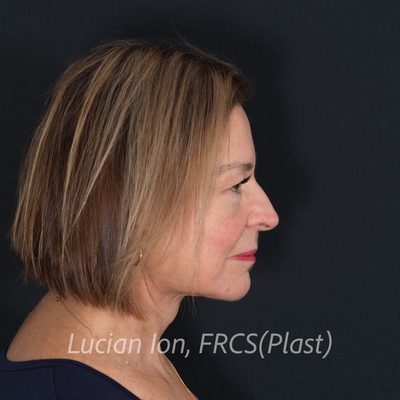 After deep contouring neck lift, case 7, profile, neck flexed view