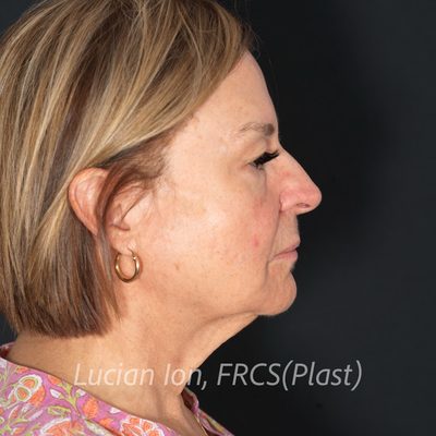 Before deep contouring neck lift, case 7, profile view