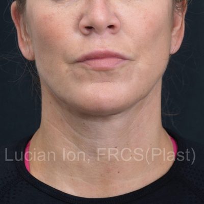 After deep contouring neck lift, case 8, front view