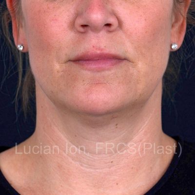 Before deep contouring neck lift, case 8, front view