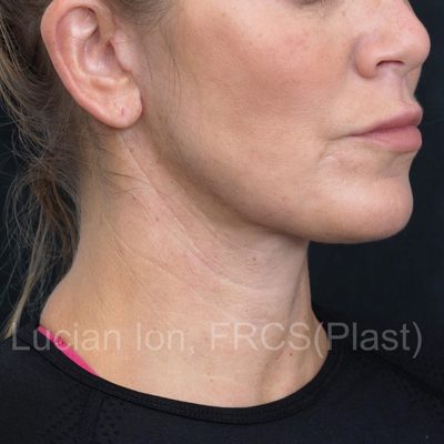 After deep contouring neck lift, case 8, oblique view