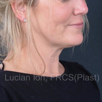 Before deep contouring neck lift, case 8, oblique view