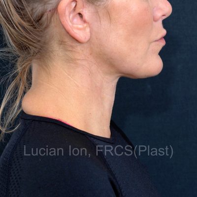 After deep contouring neck lift, case 8, profile view