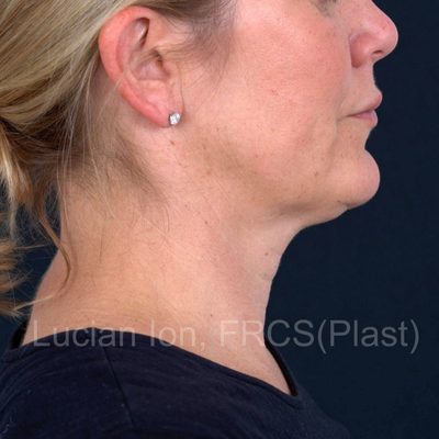 Before deep contouring neck lift, case 8, profile view