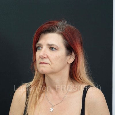 Before deep contouring neck lift, case 9, oblique view