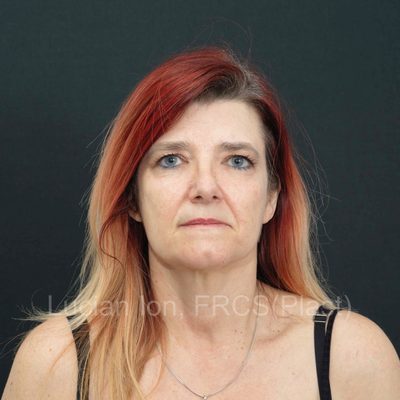 Before deep contouring neck lift, case 9, front view