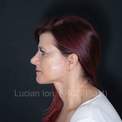 After deep contouring neck lift, case 9, profile view