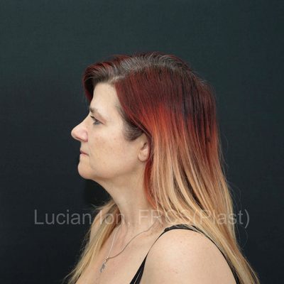 Before deep contouring neck lift, case 9, profile view