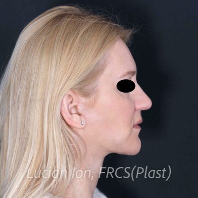 After deep contouring neck lift, case 10, profile view