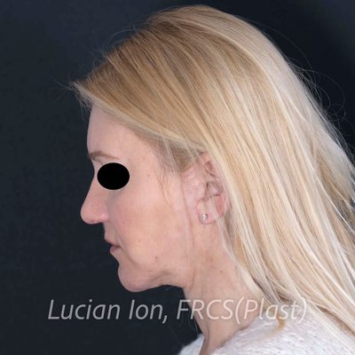 After deep contouring neck lift, case 10, profile, neck flexed view