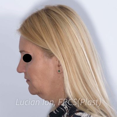 Before deep contouring neck lift, case 10, profile, neck flexed view