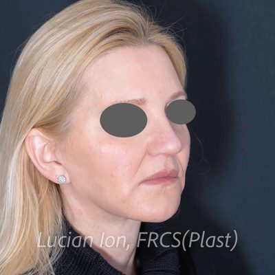 After deep contouring neck lift, case 10, oblique view