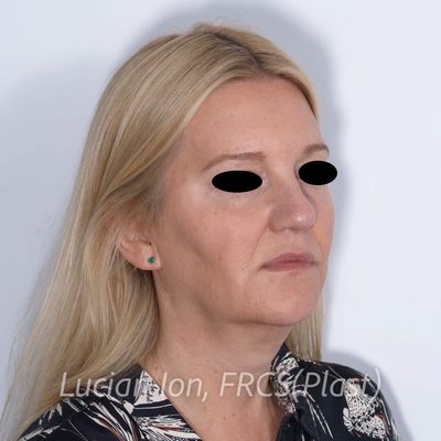 Before deep contouring neck lift, case 10, oblique view