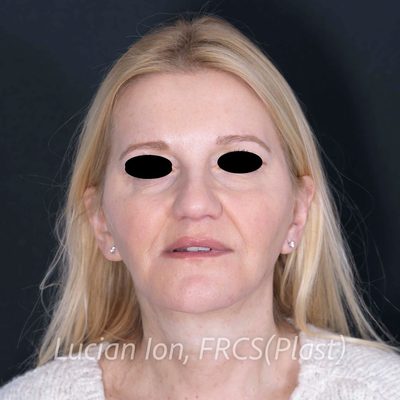 After deep contouring neck lift, case 10, front view