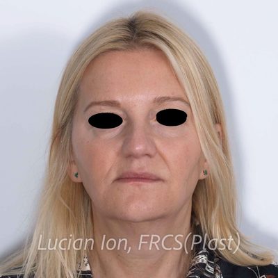 Before deep contouring neck lift, case 10, front view