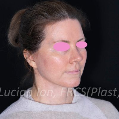 After deep plane facelift, case 1, oblique view