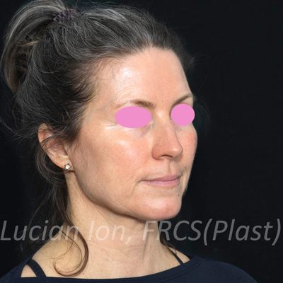 Before deep plane facelift, case 1, oblique view