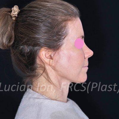 After deep plane facelift, case 1, profile view