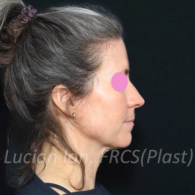 Before deep plane facelift, case 1, profile view