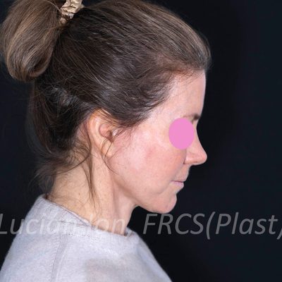 After deep plane facelift, case 1, profile, neck flexed view