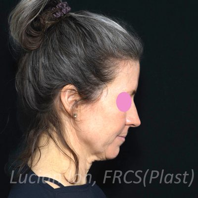Before deep plane facelift, case 1, profile, neck flexed view