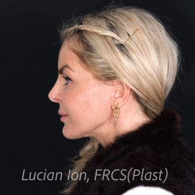 After deep plane facelift, case 2, profile view
