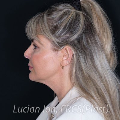 Before deep plane facelift, case 2, profile view