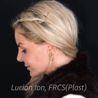 After deep plane facelift, case 2, profile, neck flexed view
