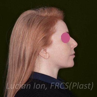 After deep plane facelift, case 4, profile view