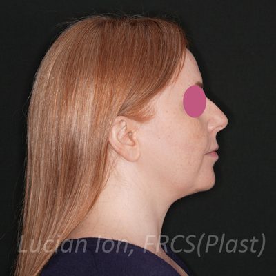 Before deep plane facelift, case 4, profile view