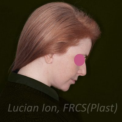 After deep plane facelift, case 4, profile, neck flexed view