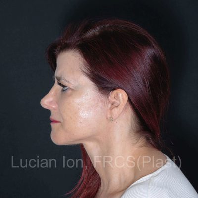 After deep plane facelift, case 5, view 3 view