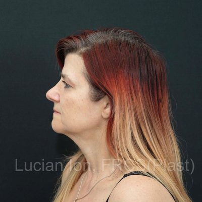Before deep plane facelift, case 5, view 3 view