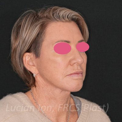 After deep plane facelift, case 6, oblique view