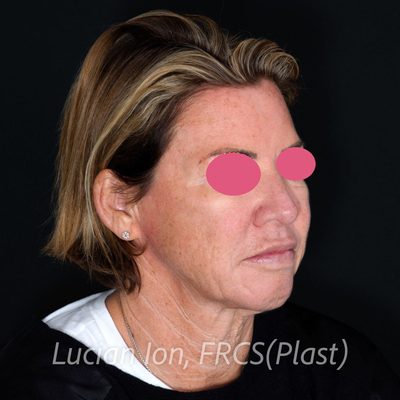 Before deep plane facelift, case 6, oblique view