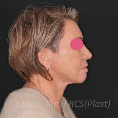After deep plane facelift, case 6, profile view