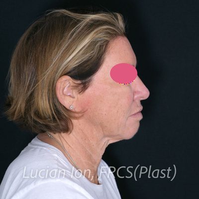 Before deep plane facelift, case 6, profile view