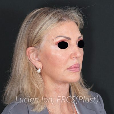 After deep plane facelift, case 7, oblique view