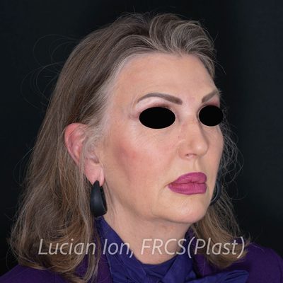 Before deep plane facelift, case 7, oblique view