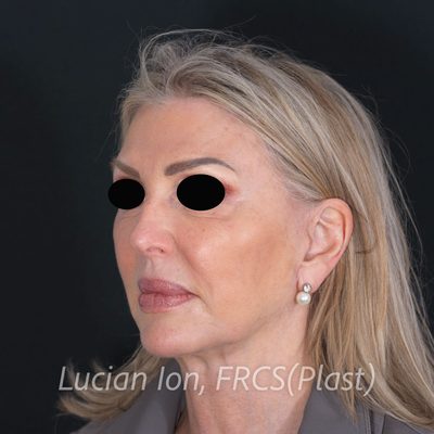 After deep plane facelift, case 7, oblique view