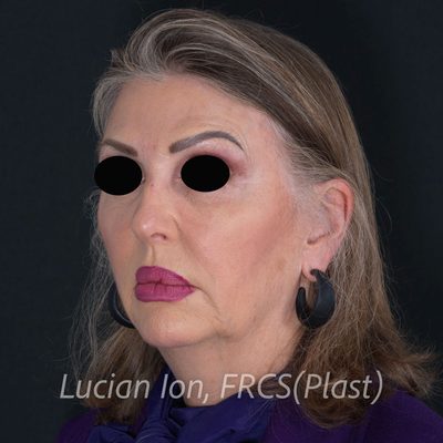 Before deep plane facelift, case 7, oblique view