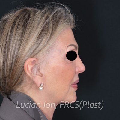After deep plane facelift, case 7, profile view
