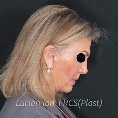 After deep plane facelift, case 7, profile, neck flexed view