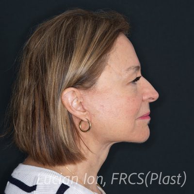 After deep plane facelift, case 8, profile view
