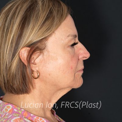 Before deep plane facelift, case 8, profile view