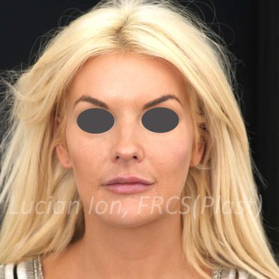 Before short scar facelift, case 1, front view