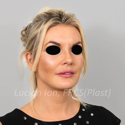 After short scar facelift, case 1, oblique view