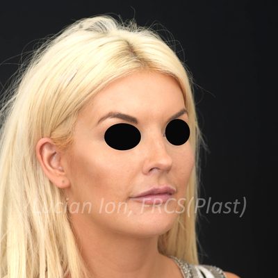 Before short scar facelift, case 1, oblique view
