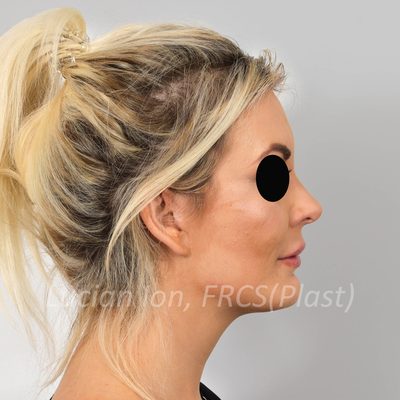 After short scar facelift, case 1, profile view